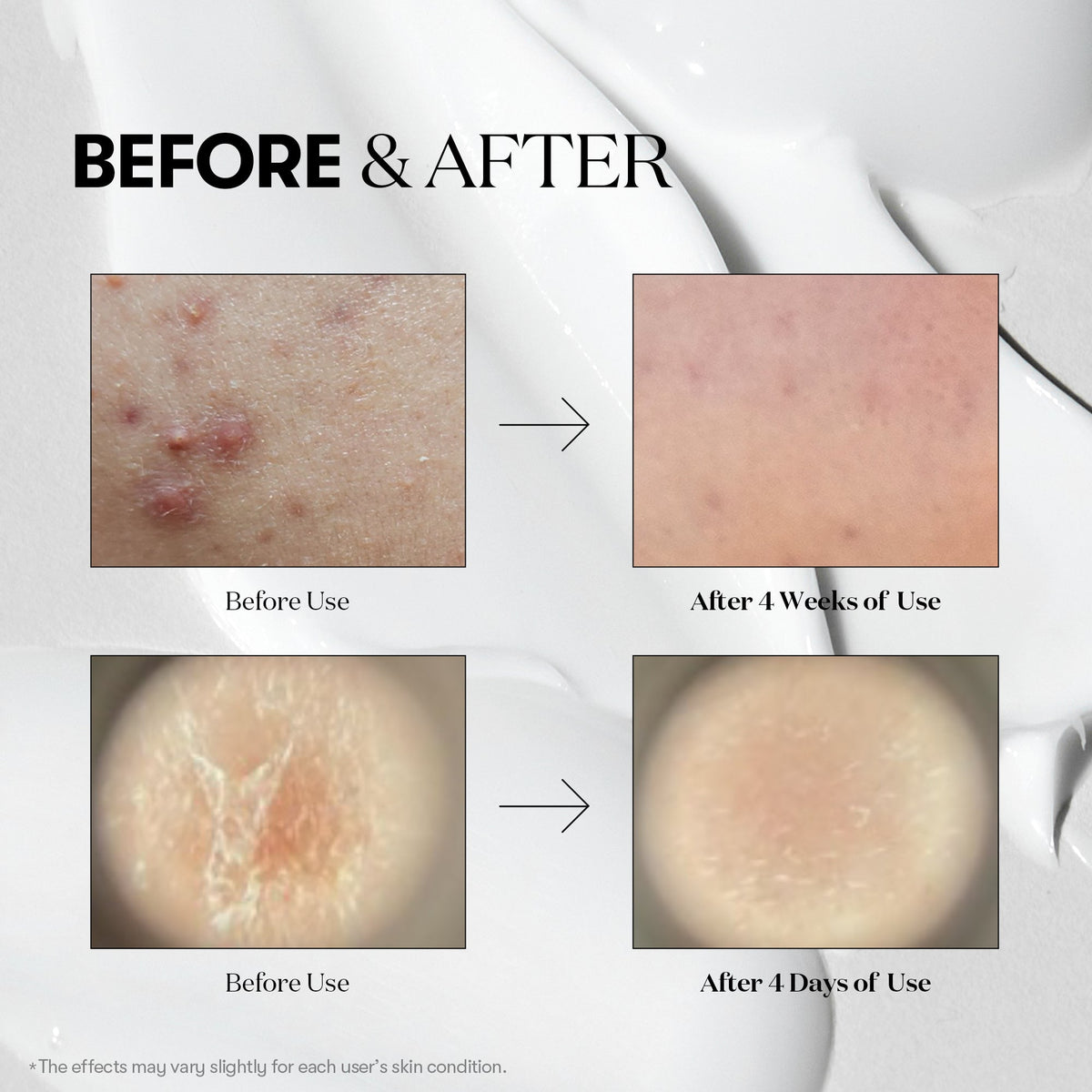 VT Cosmetics Reedle Shot 300 1.69 fl oz (50 ml) — brand before-and-after comparison graphic